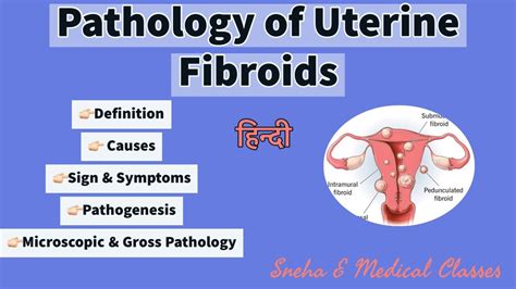 Pathology Of Uterine Fibroids Gross And Microscopic Pathology