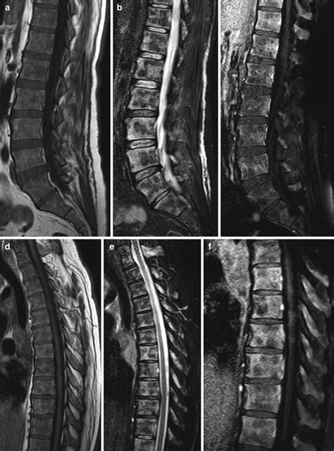 MRI of Bone Marrow Posttreatment Changes | Radiology Key