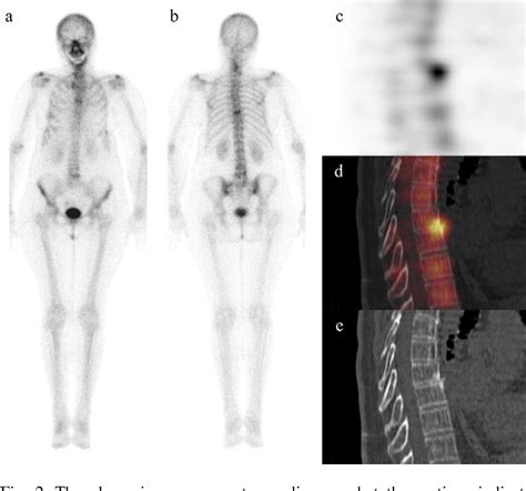 Figure From Single Photon Emission Computed Tomography Combined With