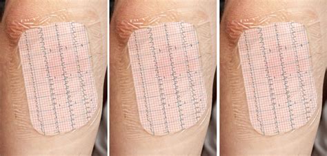 Smart Bandage Monitors Vital Signs Orthopedics This Week