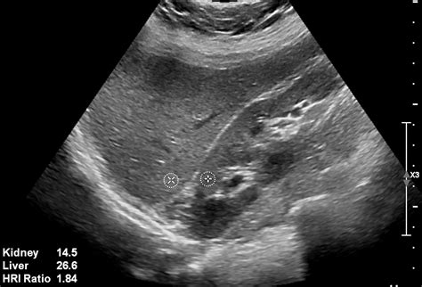 Noninvasive assessment of liver steatosis with ultrasound techniques ...