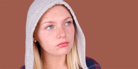 Hyperpigmentation Or Scars From Acne Difference And Treatments