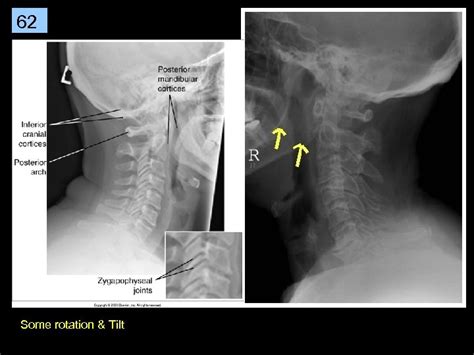 1 Cervical Spine Rtec 124 Week 6 Rev