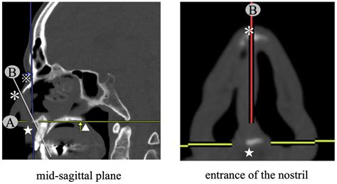 Nasopharyngeal Airway In Brain