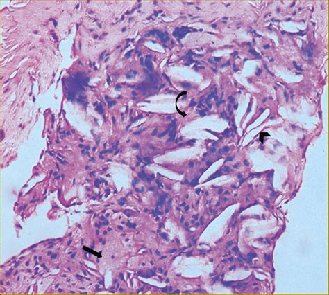 Cerebrotendinous Xanthomatosis Case Series Highlighting The Role Of Imaging In Diagnosis