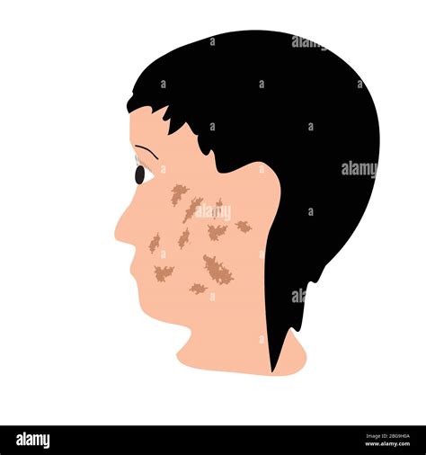 Pigmentation On The Skin A Pigmented Spot On The Skin Of The Face