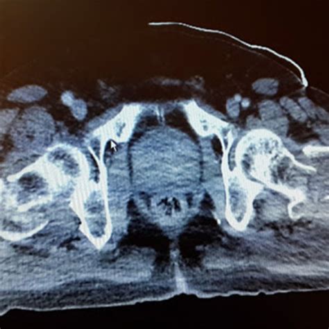 İnjury computed tomography image showing bilateral femur proximal