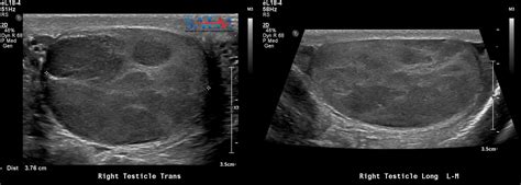 Saem Clinical Images Series Testicular Swelling Med Tac