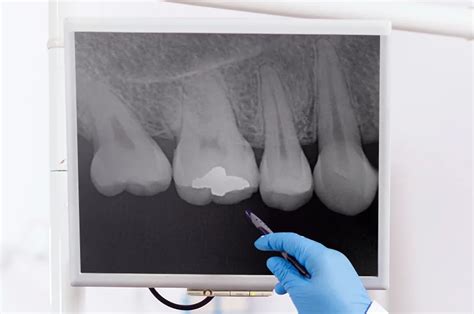 Radiografía periapical Sonrisa 3D