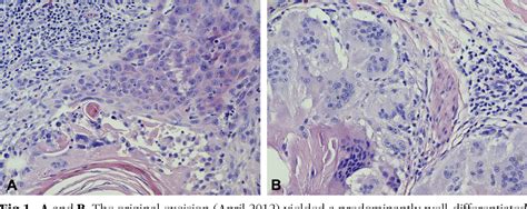 Figure From A Rare Case Of Acral Cutaneous Squamous Cell Carcinoma