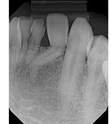 Dilaceration causes - MEDizzy