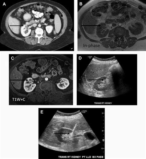 Radiomics And Artificial Intelligence For Renal Mass Characterization