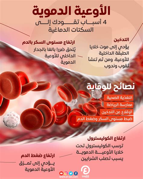 الأوعية الدموية 4 أسباب تقودك إلى السكتات الدماغية‎‎ إنفوجراف