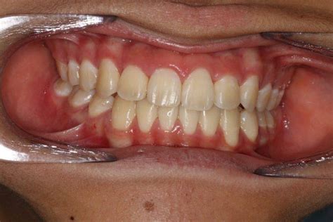 Improper Overbite And Its Correction Align Dentistry Blog