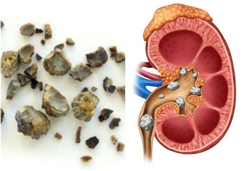 Simak Ini Gejala Tanda Dan Pengobatan Batu Ginjal Yang Perlu Kamu