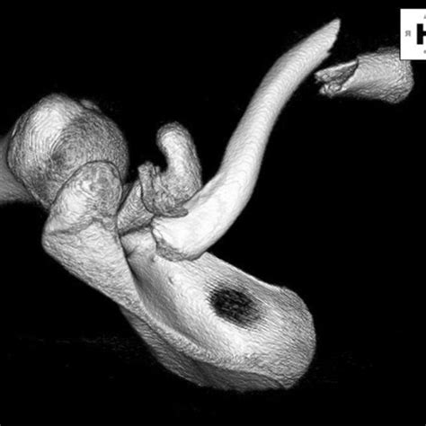 Preoperative 3-dimensional reconstruction of a computed tomography ...