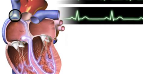 Blind Loop Syndrome Causes, Symptoms, Diagnosis and Treatment - Natural ...