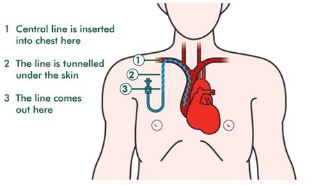 Tunneled Catheter Newest Information Chemotherapy Cancer Oncology Nursing