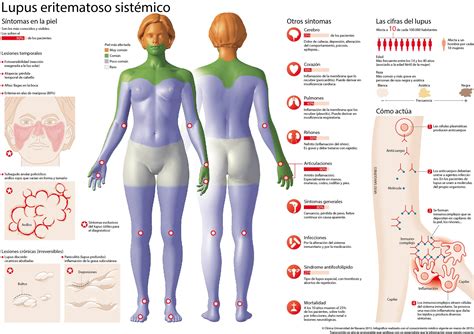 Lupus Eritematoso Sistémico Síntomas Diagnóstico Y Tratamiento Cun