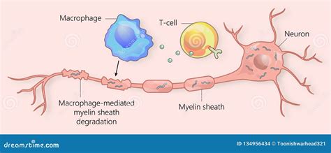 Multiple Sclerosis Animation