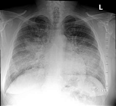 Position, Disease, Central Perihilar | Lungs