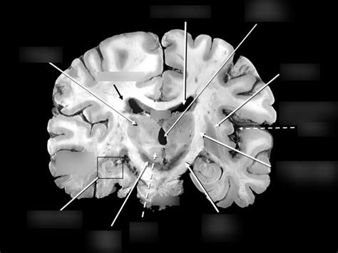Coronal Section 5 Diagram Quizlet
