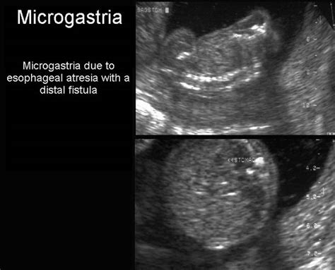 Ultrasound In Tracheo Esophageal Fistula