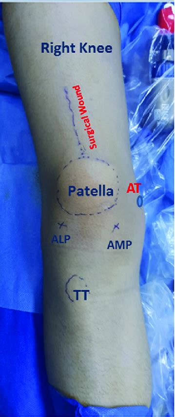 Surgical Landmarks Image Of The Front Of The Right Knee While The