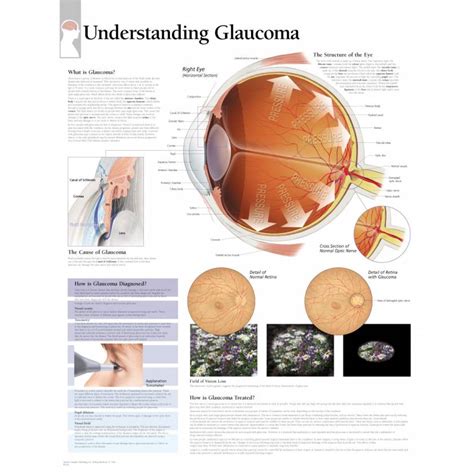 Scientific Publishing Understanding Glaucoma Chart