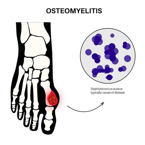 Enfermedad De Osteomielitis Dolor De Huesos De Pies Infectados Y