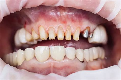 Bite Correction with Veneers or VENLAY Restorations?