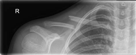 Fractures Clavicle