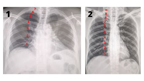 Como Avaliar a Qualidade da Radiografia do Tórax