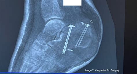 Tongue-Type Calcaneal Fracture Image 7 XR Annotated - JETem