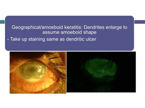 Viral Keratitis Diagnosis And Management Ppt