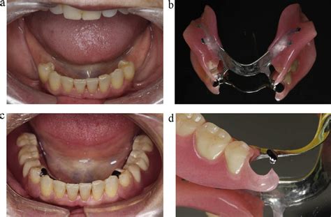 A non-metal clasp denture with a framework (Reigning N W ). (a ...