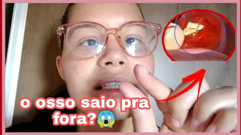 complicações da cirurgia do siso o osso saio pra fora YouTube