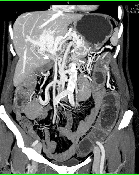 Angiodysplasia Of The Right Colon And Cavernous Transformation Of The