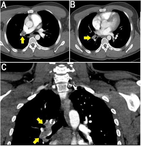 Contrasted Pulmonary Angiography Showing Thromboembolism In The Right