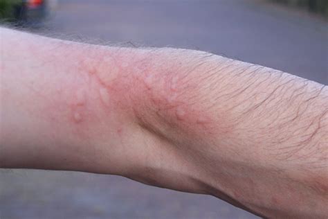 How To Avoid And Treat Brown Tail Moth Rash