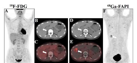 PDF Hepatic Perivascular Epithelioid Cell Tumor Resembling Hepatic