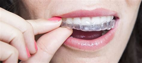 Grand Rapids Invisalign Affordable Clear Aligners And Braces