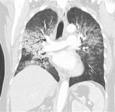 Case 1—chest computed tomography (CT) revealing signs of pneumonitis ...