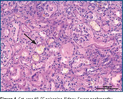 Figure 1 From Ethylene Glycol Toxicity A Retrospective Pathological