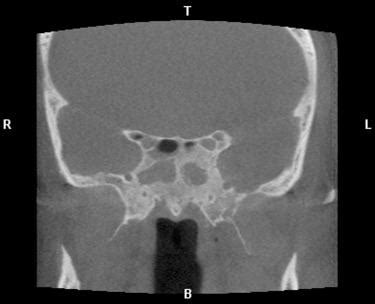 Extended Sphenoid Sinus Antrostomy and Radical Sphenoidectomy ...