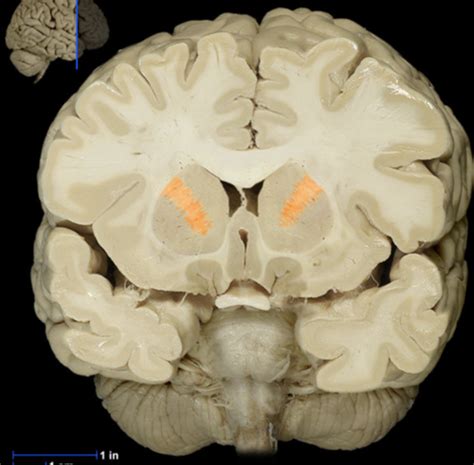 Neuro Apr Flashcards Quizlet