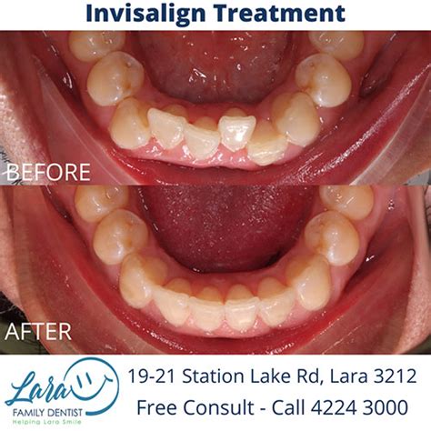 Crowded Bottom Teeth Invisalign