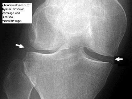 What are subchondral cysts: Hip Cysts | Subchondral Bone Cysts