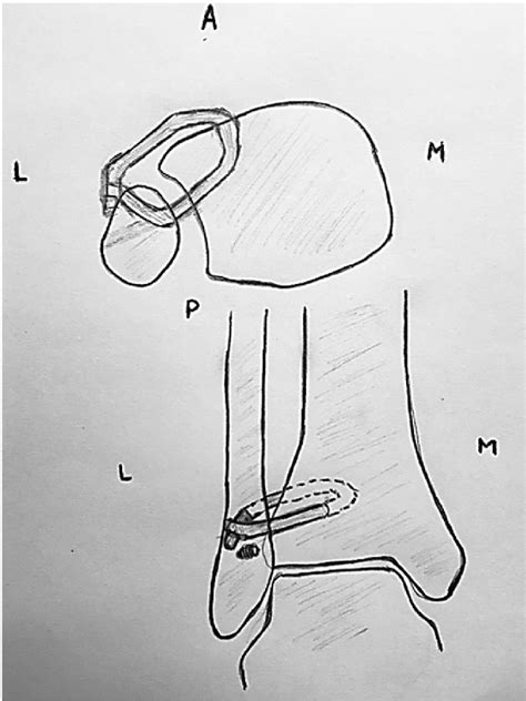 Figure 3 From Reconstruction Of Tibiofibular Syndesmosis Using