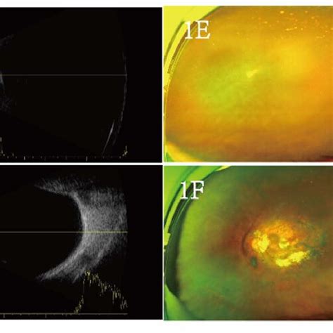 The Patient Underwent Anterior Segment Photography Ocular Ultrasound Download Scientific